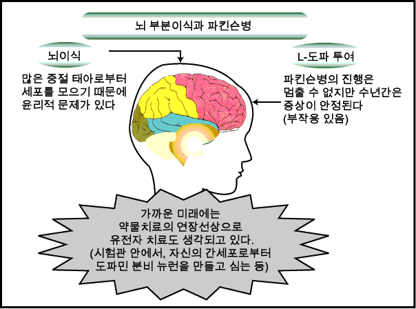 뇌세포 이식과 파킨슨병 치료